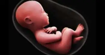 Correlation of bladder pain syndrome with neonatal outcomes and pregnancy