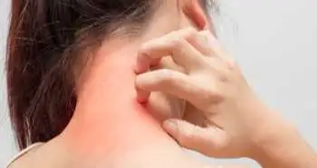 dermatitis