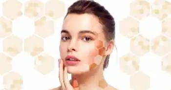 melasma