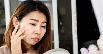 акне