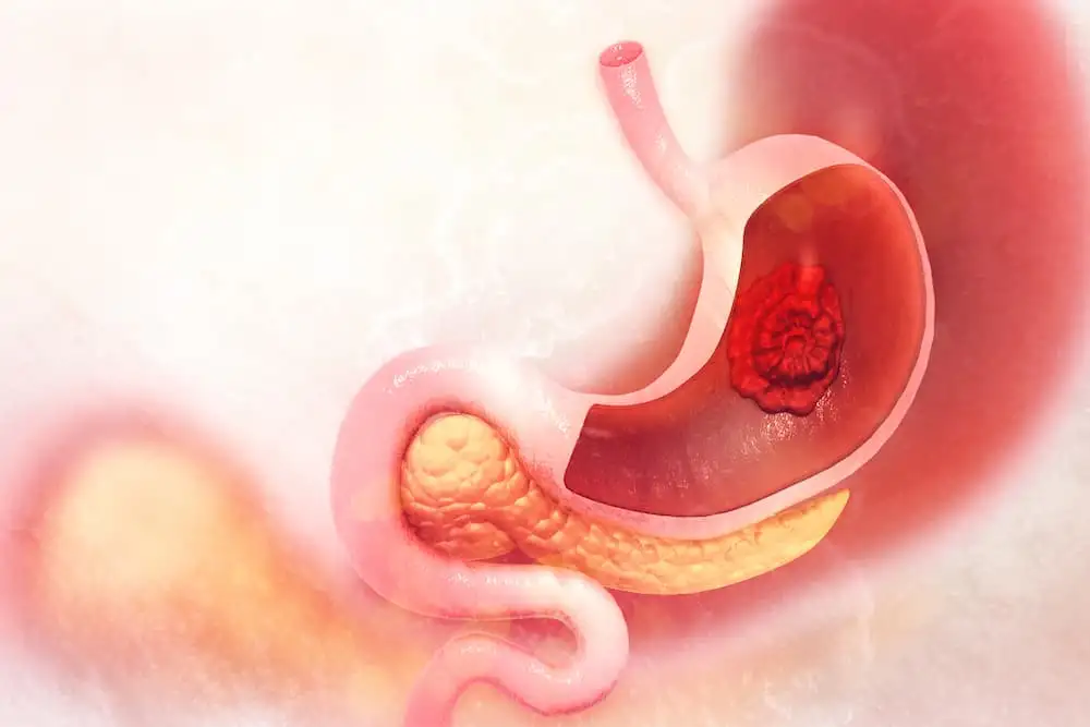 спричинена H. pylori