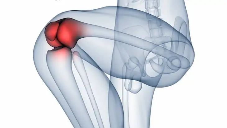 остеоартроз колінного суглоба