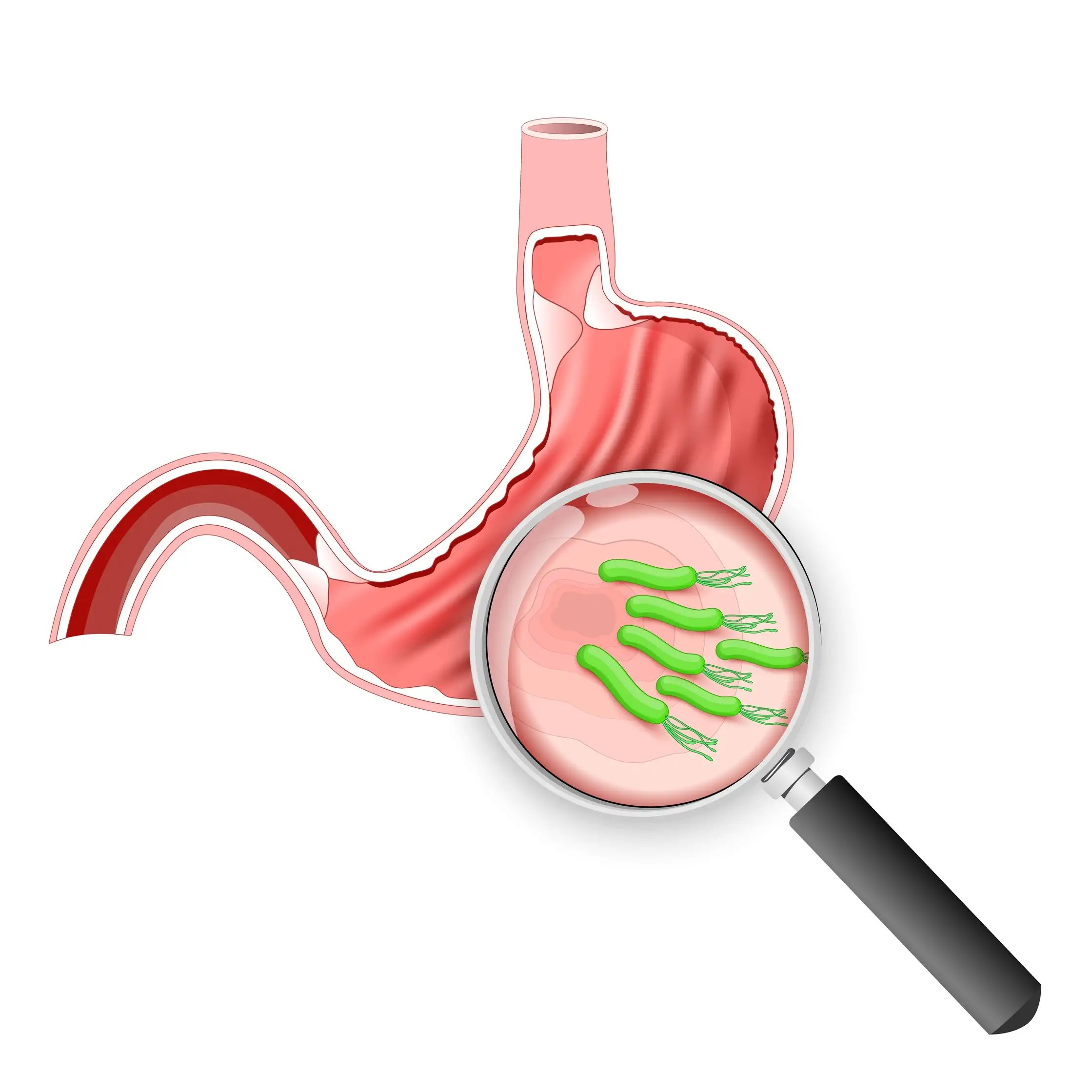 інфекція H. pylori
